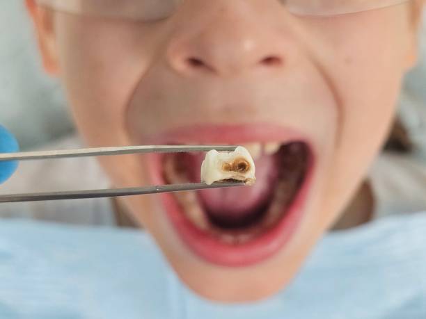 Best Knocked-Out Tooth (Avulsed Tooth) Treatment in Greenville, OH